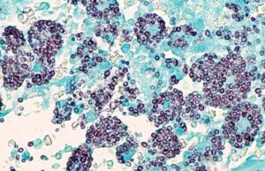 Un hongo raro y mortal está enfermando a la gente en Tennessee