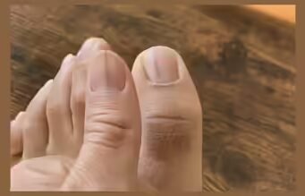 Débiles líneas negras en las uñas: ¿inofensivas o signo de cáncer de piel agresivo? La publicación de Reddit se vuelve viral