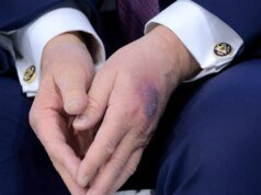 La Casa Blanca explica el hematoma en la mano de Trump